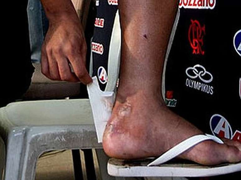 A blister on Adriano's left foot kept him out of a crucial match for Flamengo -