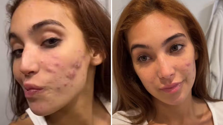 Vanessa Lopes mostra evolução em tratamento da acne. À esquerda, como era antes e à direita como era depois