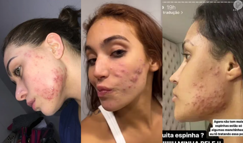 Vanessa Lopes, Ana Castela e mais famosas que falam abertamente sobre autoestima e luta contra a acne.