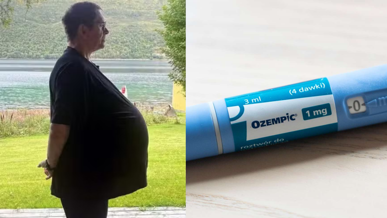 M&eacute;dico descobre que 'obeso' tratado com Ozempic tinha na verdade um tumor de 27kg