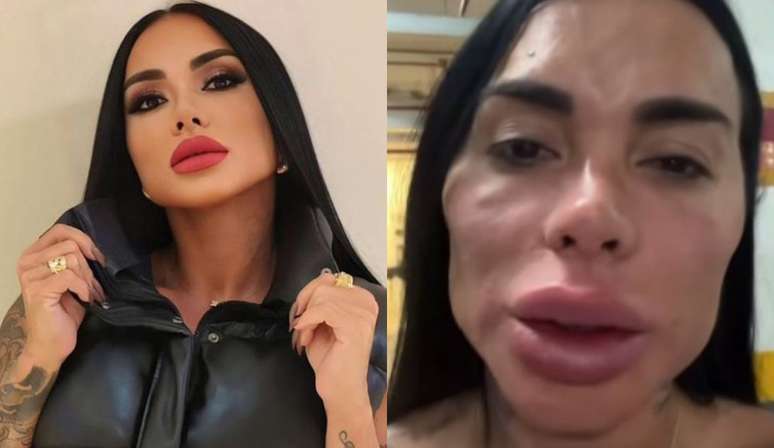 Kamila Simione antes e depois da harmonização facial