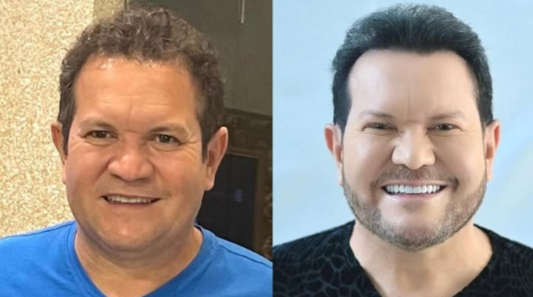 Ximbinha faz lipo de papada e rinoplastia e diz estar feliz com resultados: ‘Estou gostando disso’