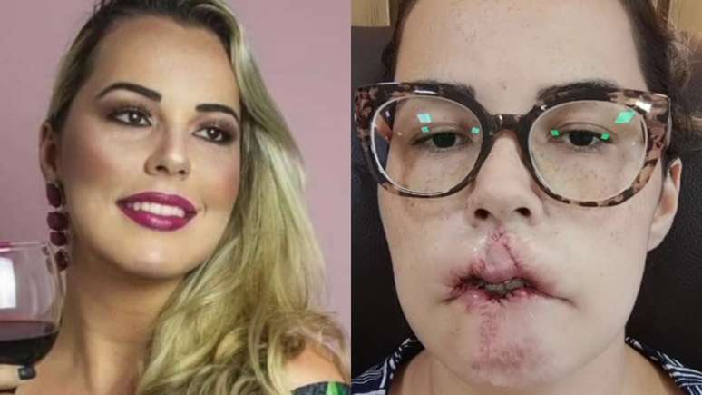 The influencer loses her lip after having fillers with banned substances
