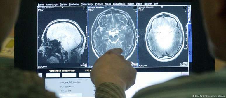 Desenvolvimento de medicamentos eficazes contra o Alzheimer é desafiador porque muitos processos cerebrais relacionados à doença ainda não são totalmente compreendidos