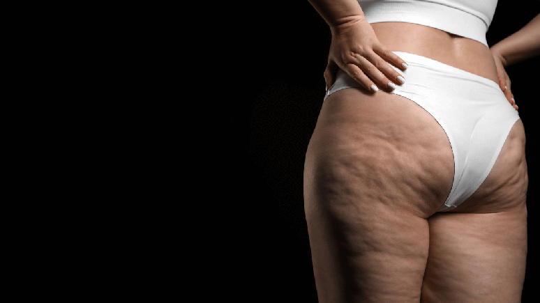 O lipedema resulta no acúmulo de gordura, se assemelhando à celulite / Foto: Shutterstock