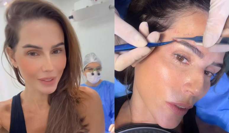 Deborah Secco antes e durante o transplante de sobrancelha, nesta segunda-feira, 2