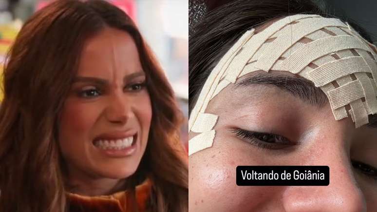 Que procedimento Anitta fez no rosto? Médico analisa caso controverso