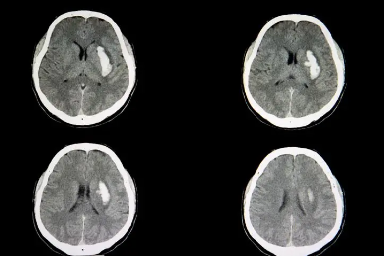 Exames de imagem ajudam a diagnosticar a hemorragia intracriana e a extensão da lesão no cérebro