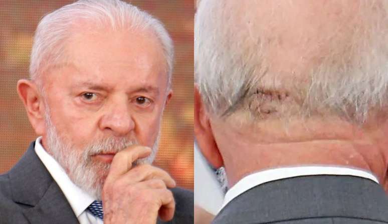 Lula e a cicatriz do tombo no banheiro: sangramento posterior pressionou o cérebro