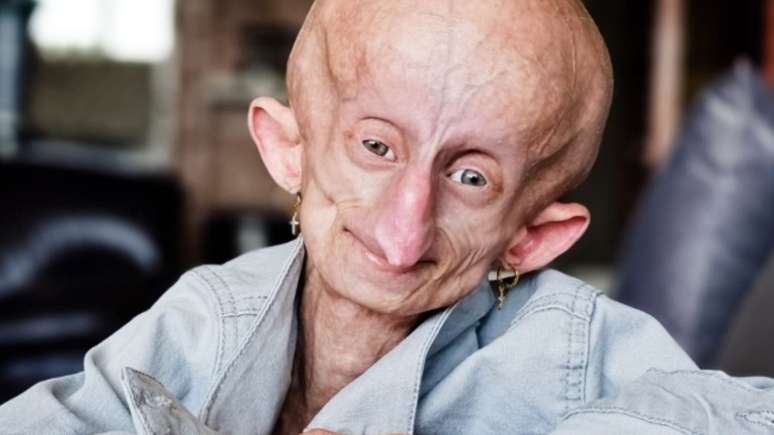 O que é progeria? Jovem de 19 anos morreu após doença do envelhecimento precoce