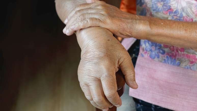 No calor, o inchaço das mãos é muito comum, sendo assim, a Clínica Mayo deu alguns conselhos para diminuir o inchaço; confira