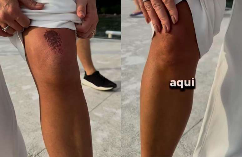 Juliana Pavan mostra ferimento após ser atropelada por patinete