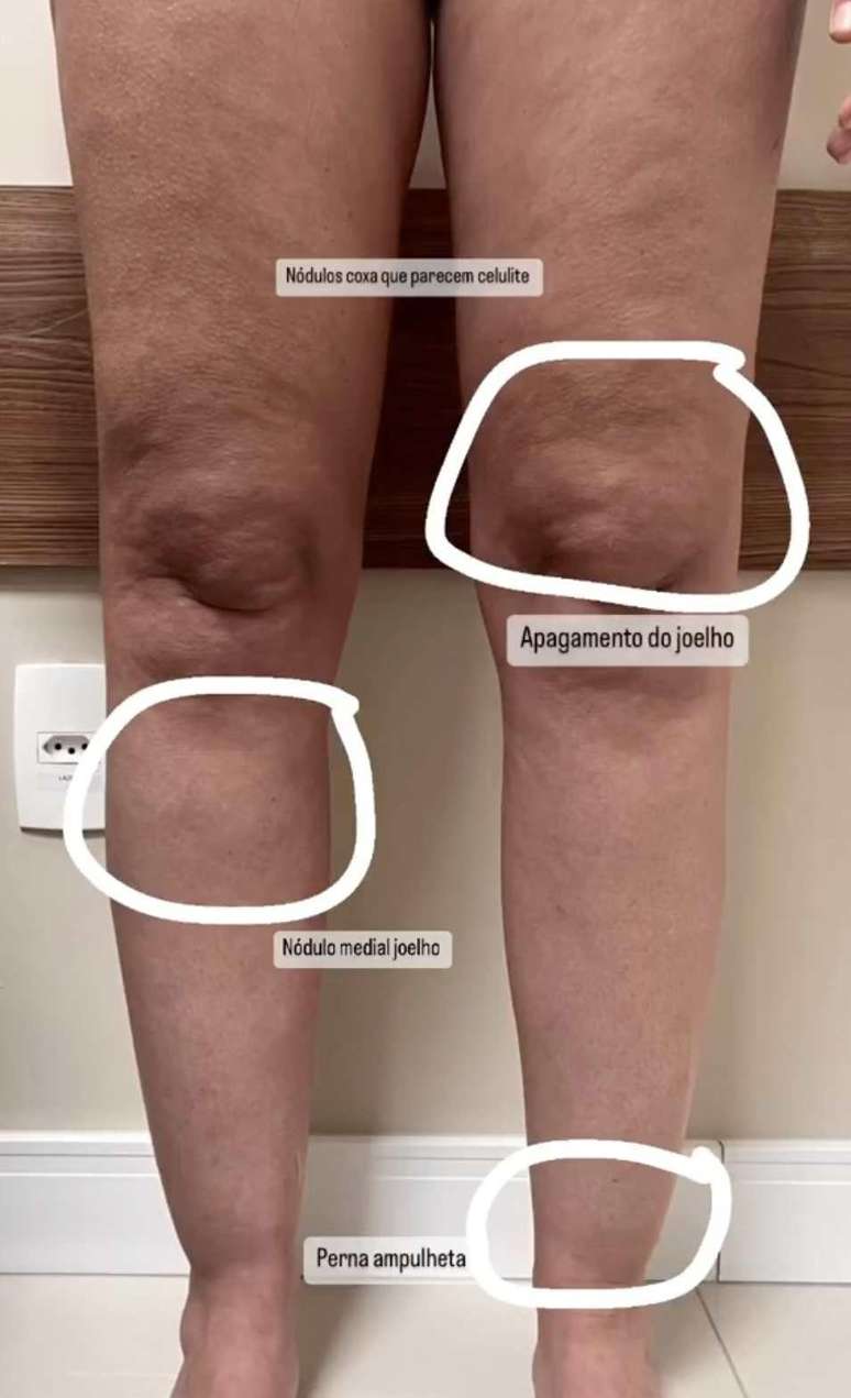 Um vídeo publicado pela médica Thais Torres, cirurgiã vascular, mostra alguns sinais visuais específicos do lipedema