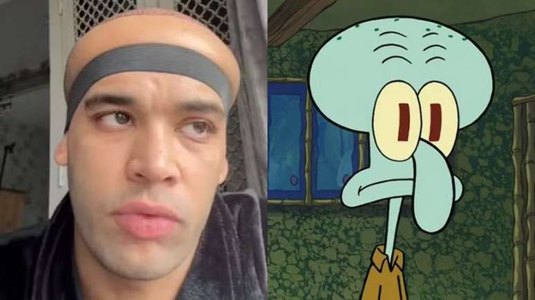 Choreographer Spaire with head size after hair transplant: “Mollusk” Lula “