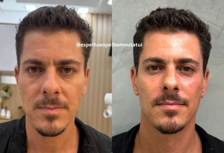 Sacha Bali, vencedor de A Fazenda 16, usou suas redes sociais nesta quinta-feira, 7, para revelar que realizou procedimentos estéticos.