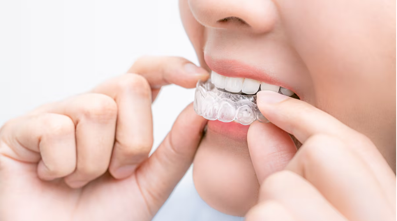 Abuso de métodos de clareamento dental pode causar prejuízos à saúde bucal e indicar um quadro de insatisfação com a própria imagem