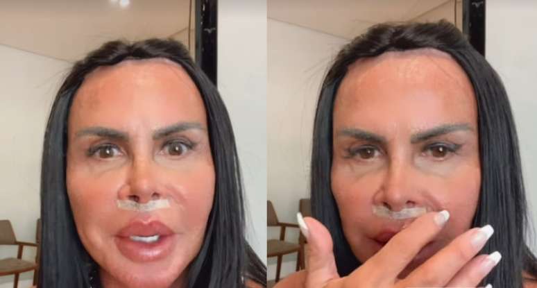 Após décadas, cantora decidiu remover preenchedor labial