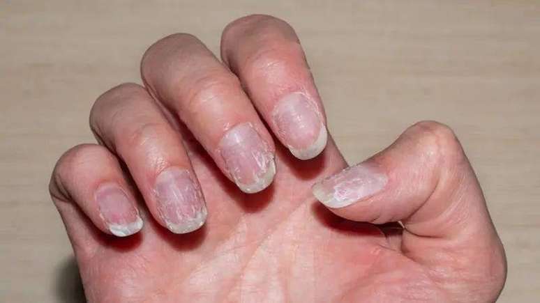 Foto de uma mão com as unhas esbranquiçadas. 