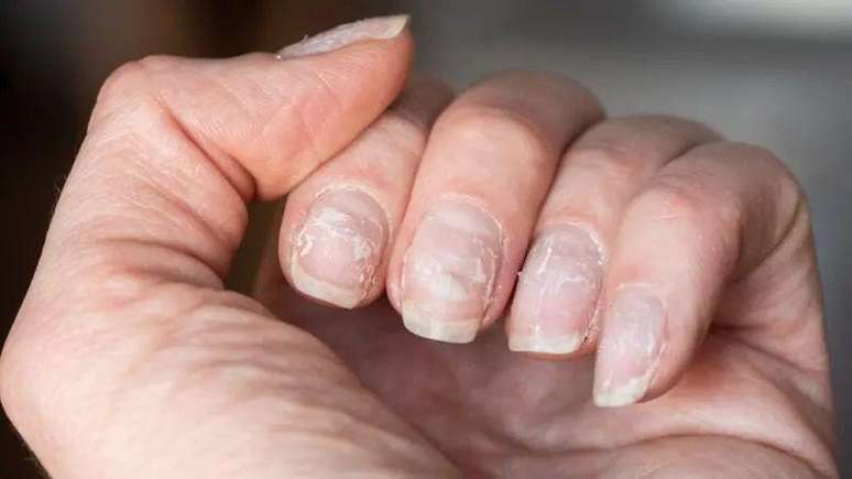 Foto de unhas esbranquiçadas. 