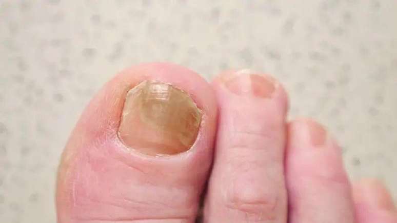 Foto de um pé com a unha do dedão escura.