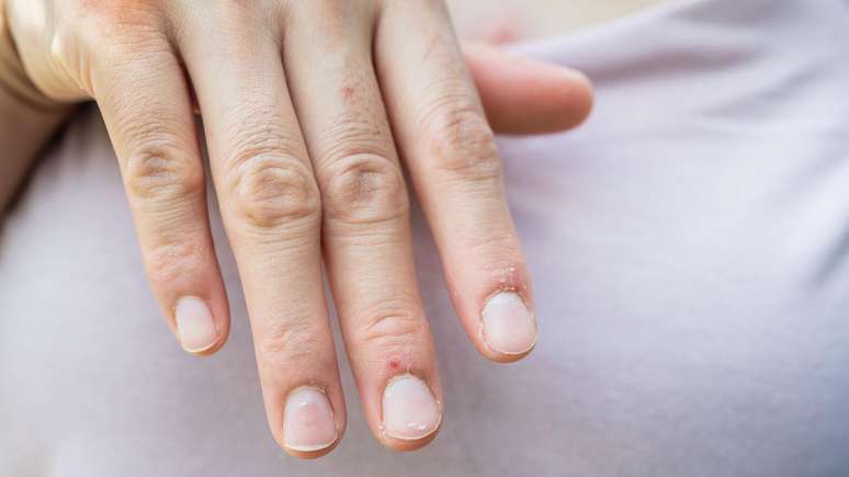 As unhas podem apontar diversos problemas de saúde