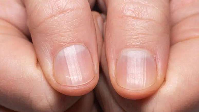 Foto de dois dedões com pontinhos brancos nas unhas. 