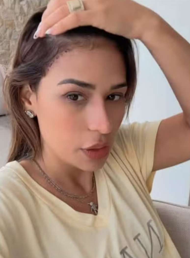 Simone mostra a cicatriz do lifting temporal -