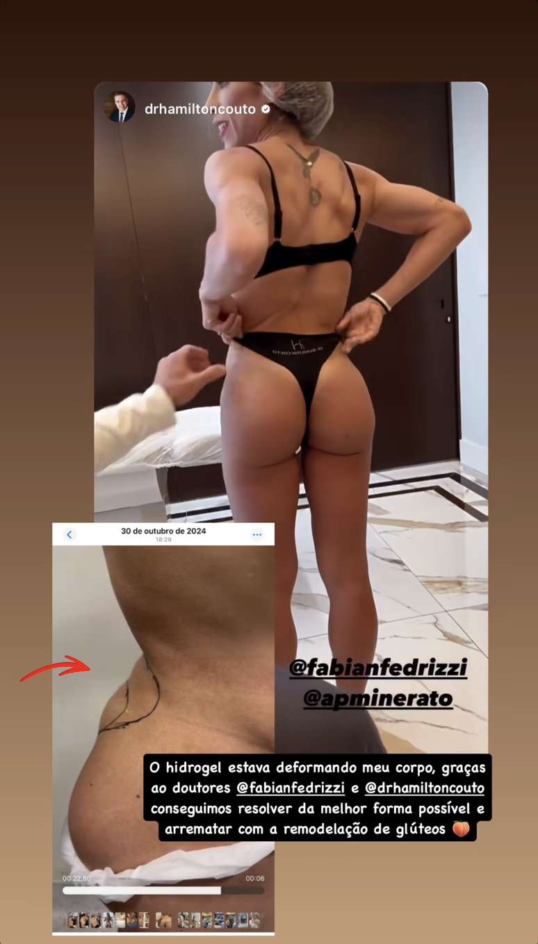Ana Paula Minerato remove hidrogel do bumbum
