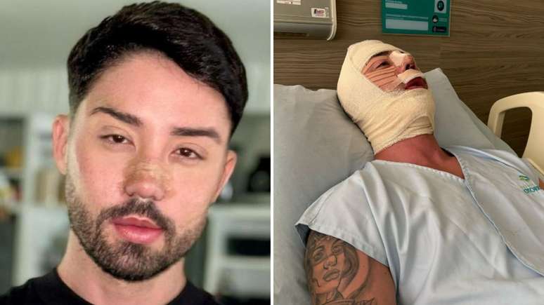 Rico Melquiades surge irreconhecível ao passar por 11ª cirurgia: 'Refiz'