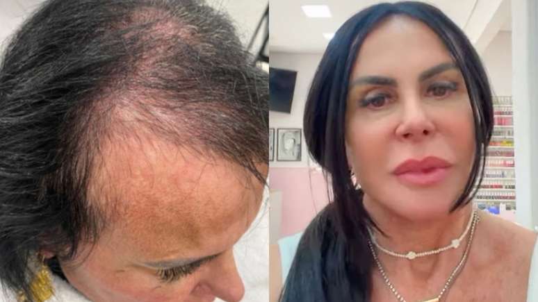 Gretchen shows stronger threads after treatment with alopecia; See the first and after!