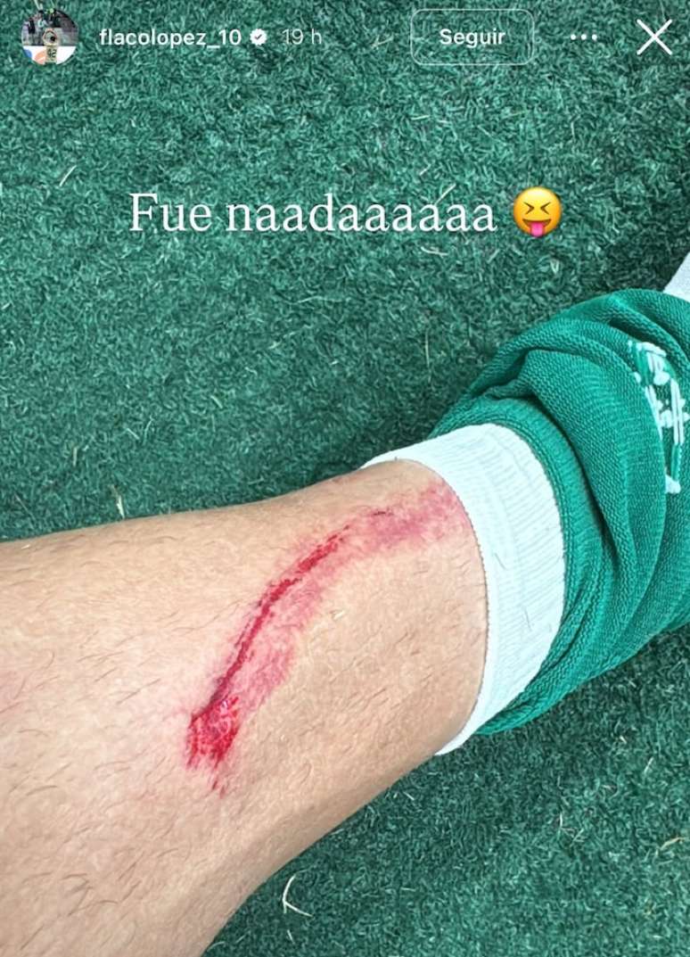 Flaco López posta foto de machucado: 'Foi nada'
