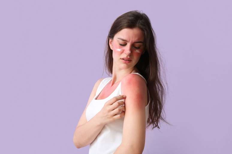 Cuidados simples ajudam a recuperar a pele após a queimadura de sol