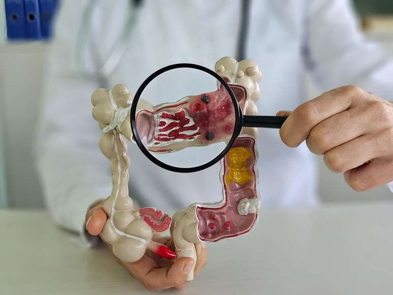 O diagn&oacute;stico precoce &eacute; essencial no tratamento do c&acirc;ncer colorretal