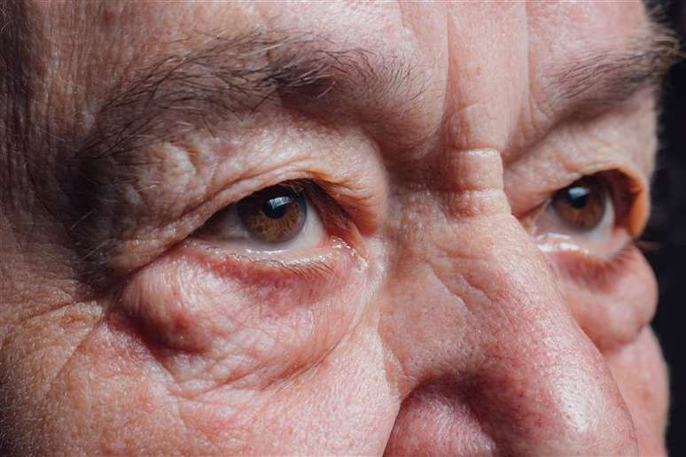 The excess skin on the eyelids can be correct
