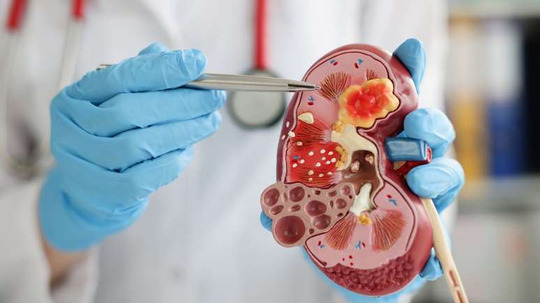 Esses grãozinhos se juntam e formam uma ou mais pedras no rim, mas também podem aparecer dentro do ureter ou na bexiga