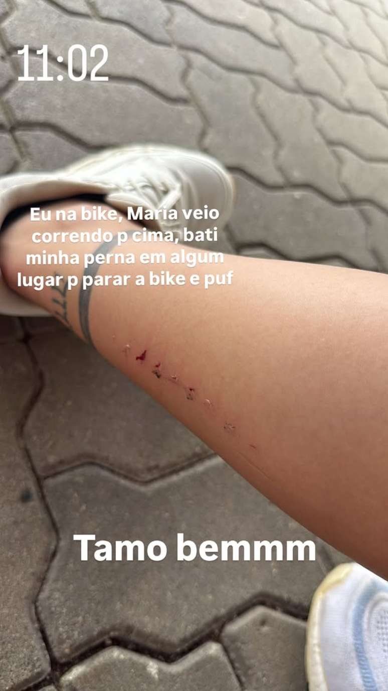 Virginia mostra cortes na perna após cair de bicicleta
