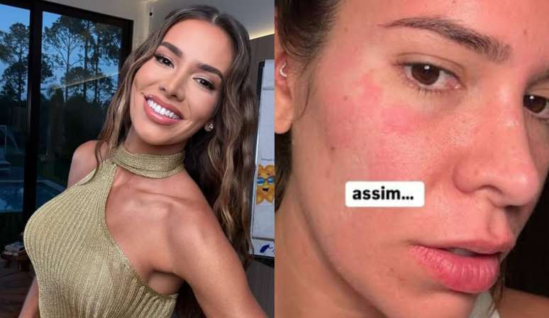 Medical Warns of the condition of the former BBB Adriana Sant’Anna: “Diagnosis is not simple”