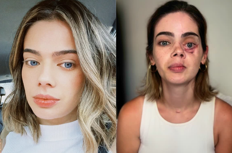 Ana Luiza Prestes, cirurgiã-dentista de 29 anos, passou por cirurgia para a retirada do tumor