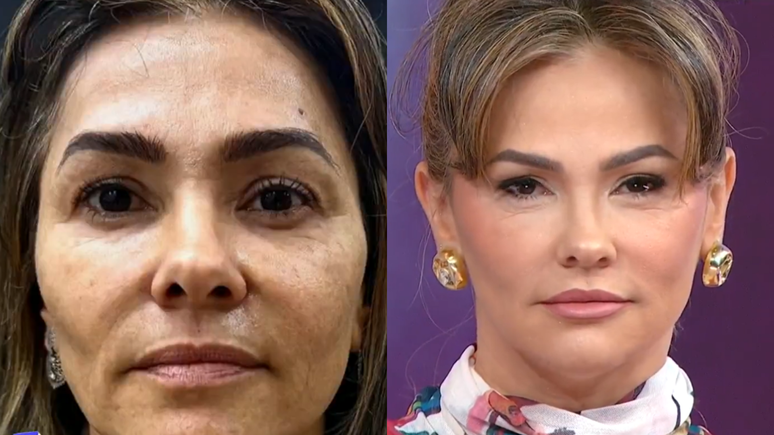 Before and after the facial harmonization of Tiazinha Before and after the facial harmonization of Tiazinha