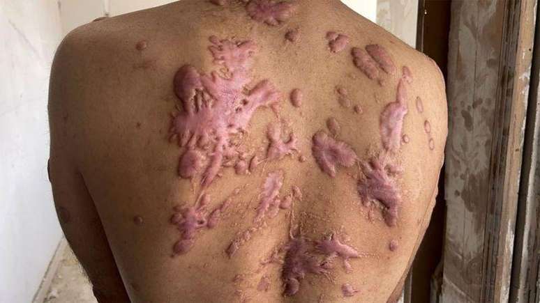 As costas de Mohammad Abu Tawileh est&atilde;o cobertas de verg&otilde;es vermelhos