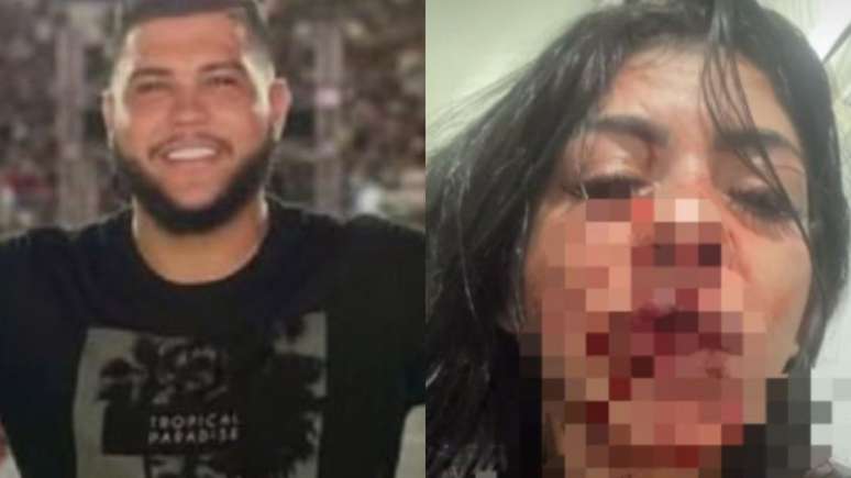 Absurdo! Cantor de forró chora após socar a namorada e deixá-la sem os dentes