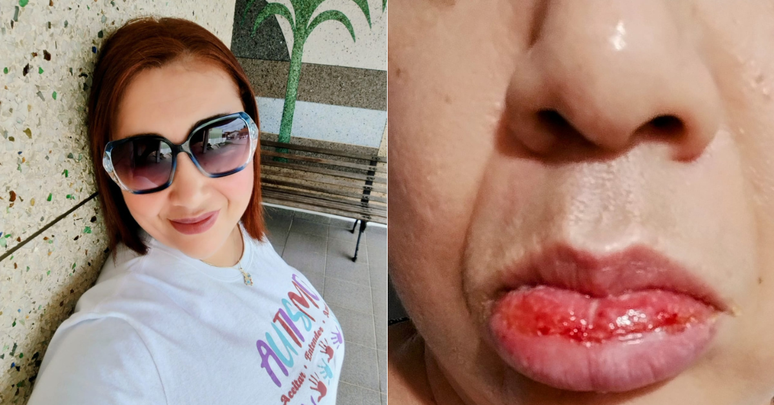 Educadora mostra antes e depois de uso de creme dental interditado pela Anvisa
