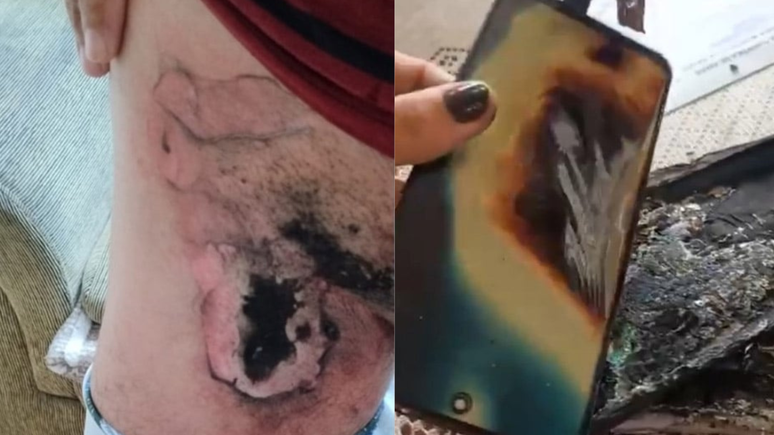 Homem fica com queimaduras de 3&ordm; grau na perna ap&oacute;s celular explodir - Reprodu&ccedil;&atilde;o/G1
