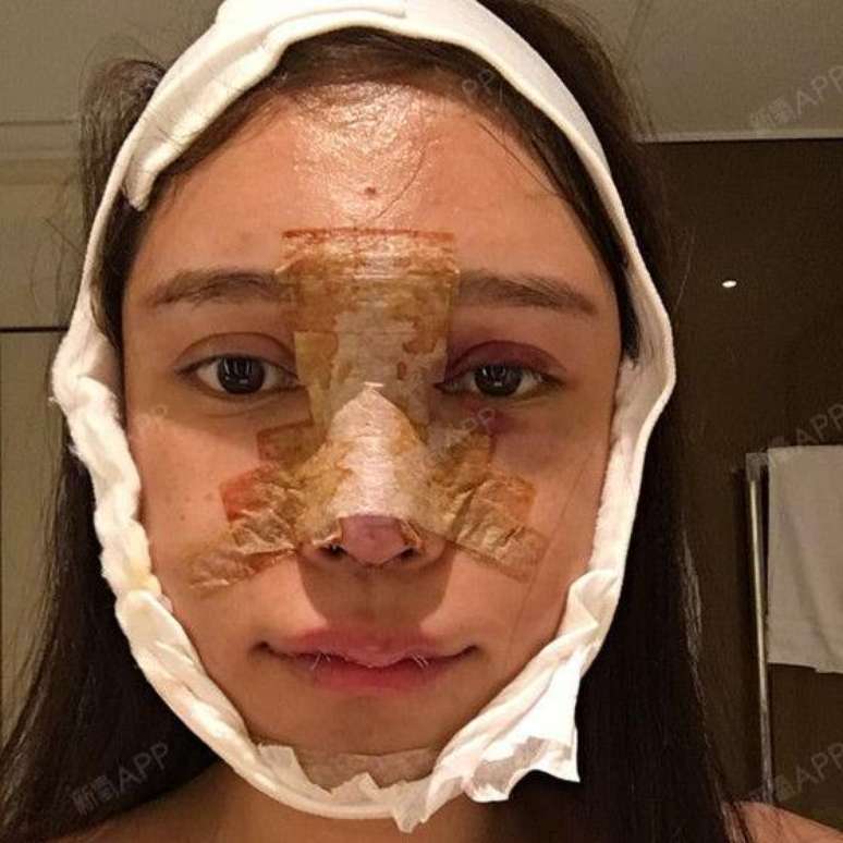 Abby documenta sua jornada de cirurgia plástica nas redes sociais, mostrando algumas das realidades de 'entrar na faca'