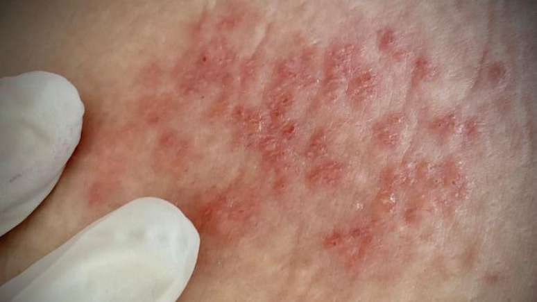 O herpes zoster acontece pela reativa&ccedil;&atilde;o do v&iacute;rus varicela, que inicialmente causa a catapora