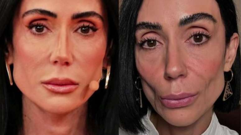 The filling of the exaggerated face causes a drop to Michelle Barros, explains Expert
