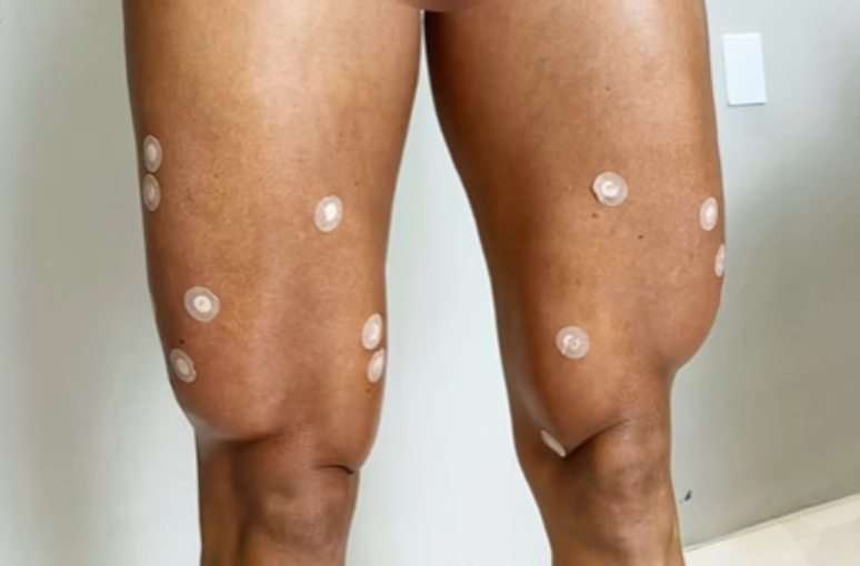 What is the harmonization of the quadriceps and what are the risks?