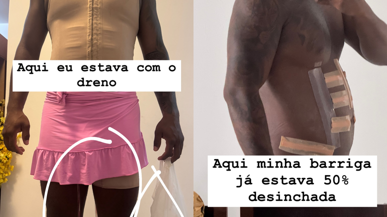 David Brito shows HD Lipo's results almost two weeks after surgery
