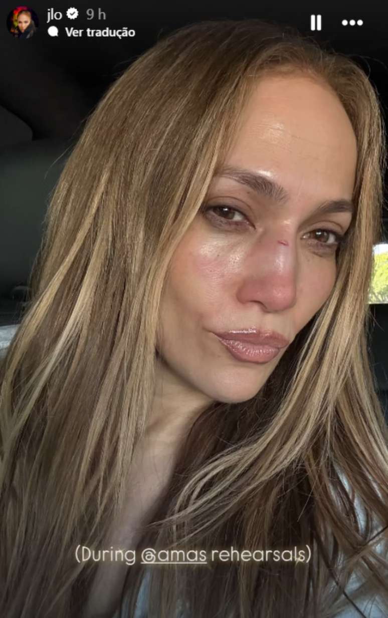 Jennifer Lopez mostra corte após acidente em ensaio de premiação