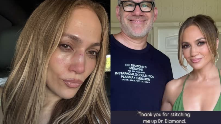 Jennifer Lopez sofre acidente em ensaio de premiação e leva pontos no rosto